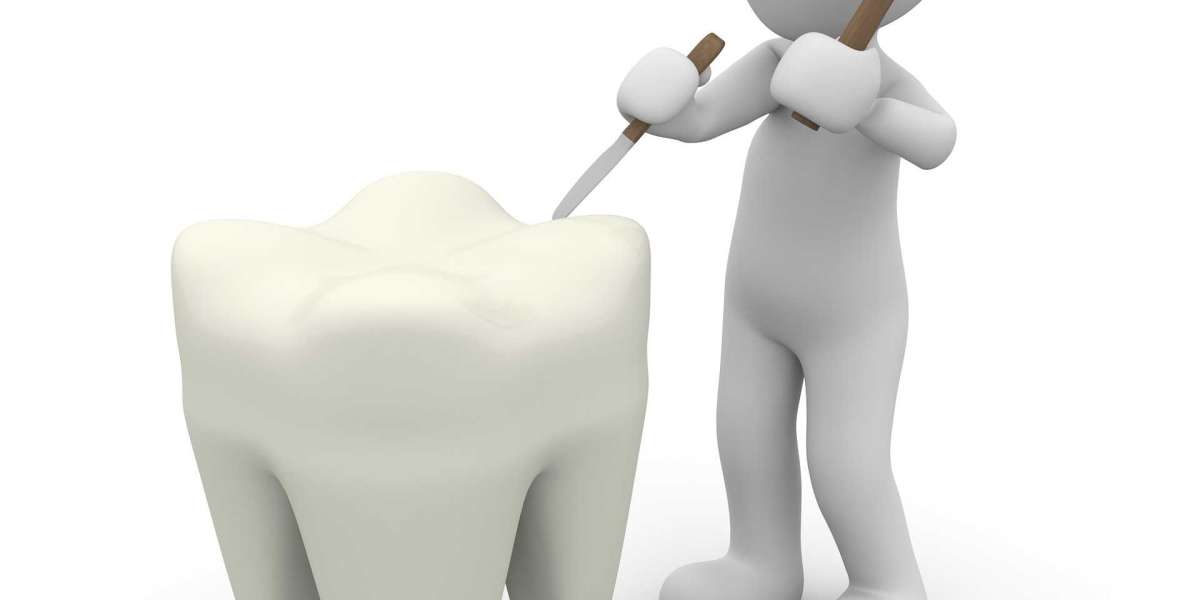 Frequently Asked Questions about the Best Dental Implants
