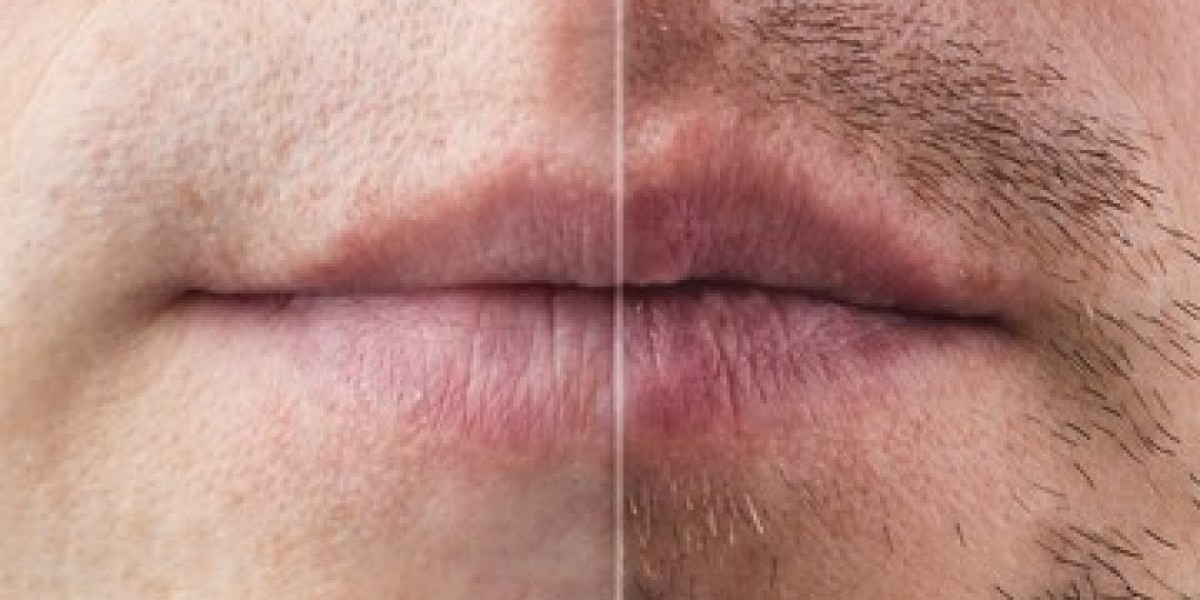 Best Beard Transplant Los Angeles