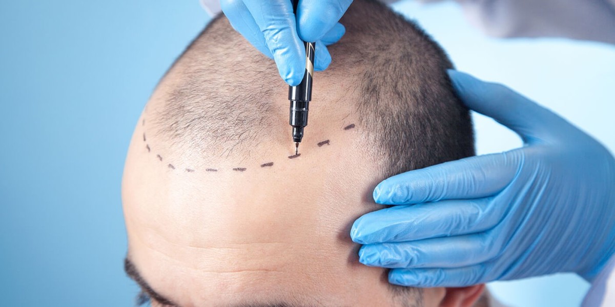 Best Hair Transplant in Delhi