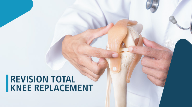 Choosing the Right Surgeon for Your Revision Total Knee Replacement in Delhi - AtoAllinks