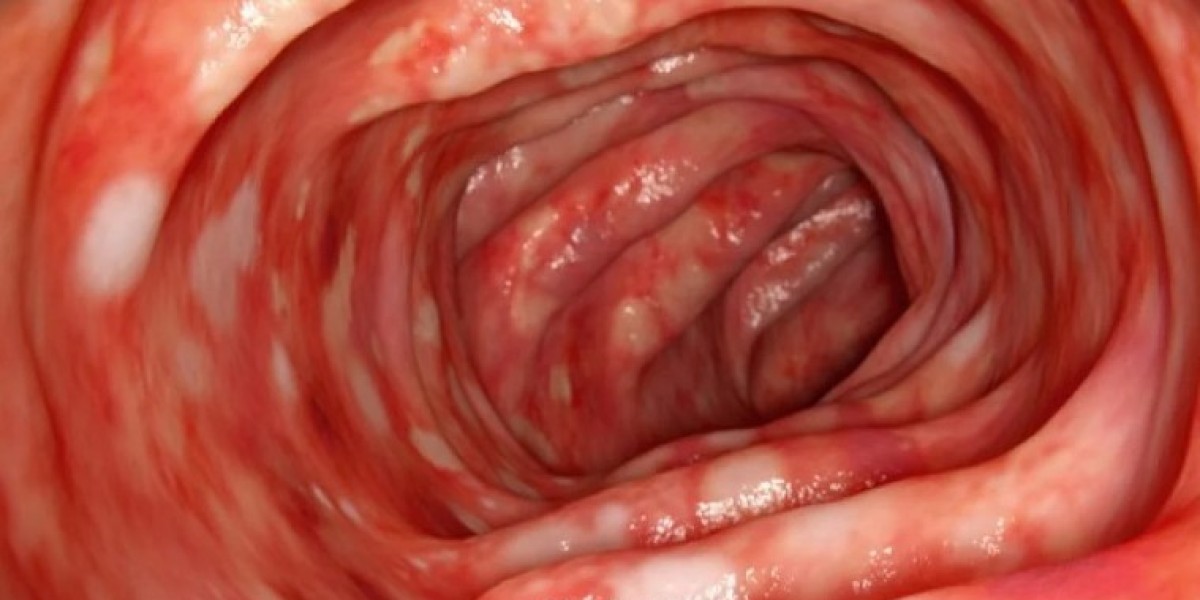 Ulcerative Colitis Treatment: Could Your Diet Be the Ultimate Cure?