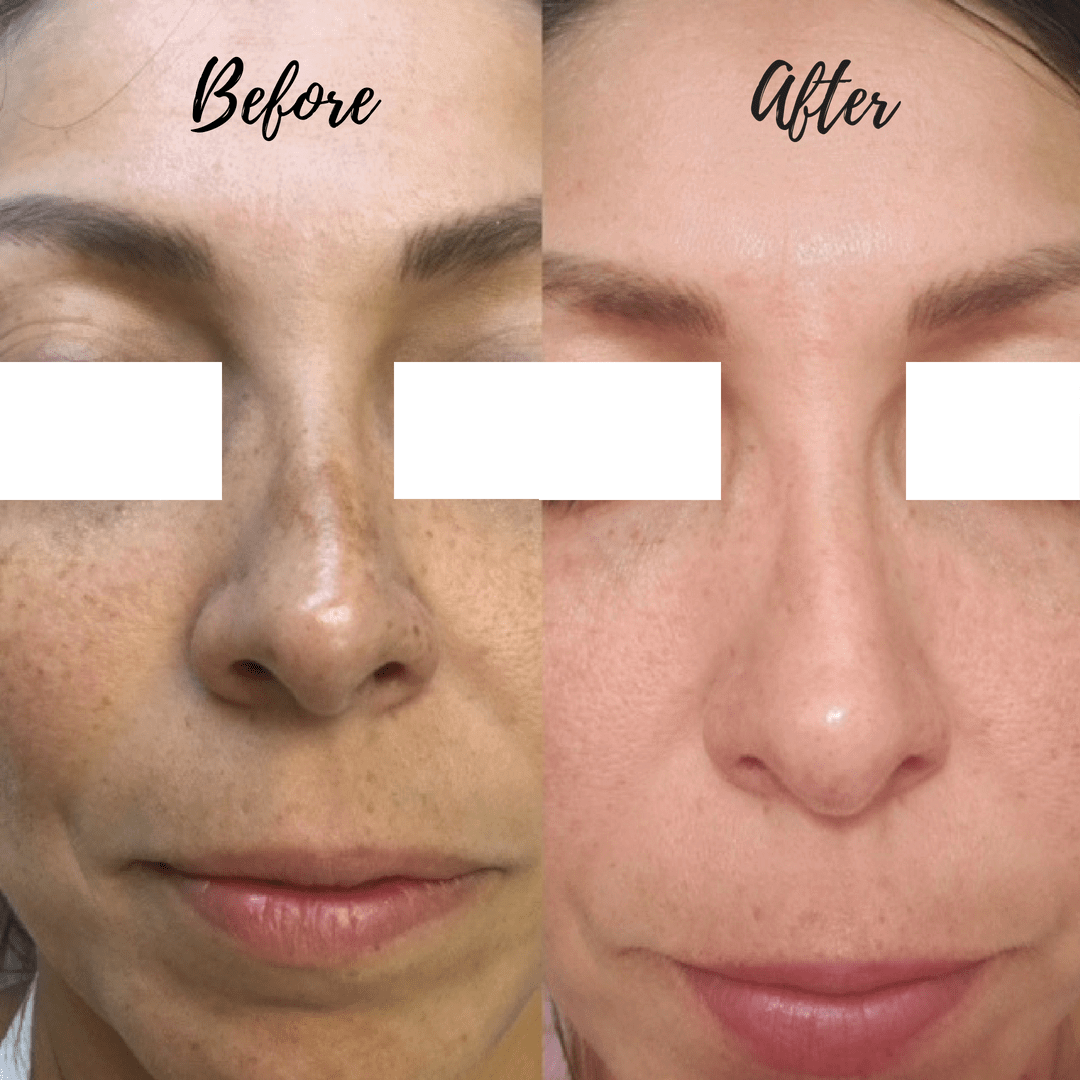 Best Treatment for Age Spots on Face in Palm Beach Gardens | La Vie Spa