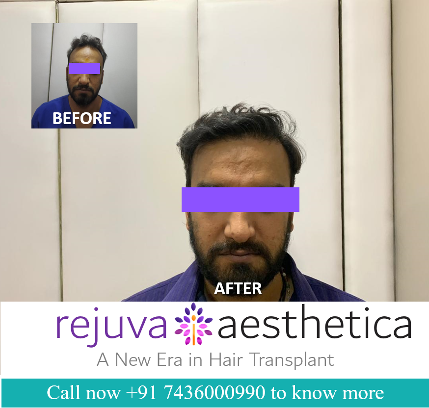 Hair Transplant Cost in Ahmedabad,Gujarat | Rejuva Aesthetica Plastic Surgery Clinic in Ahmedabad